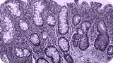 colitis-ulcerosa